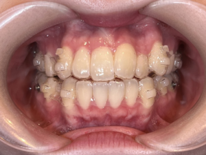 マウスピース矯正 インビザライン 矯正歯科 専門医