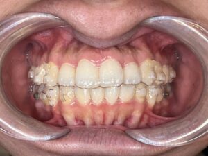 秋葉原リヨンドール歯列矯正歯科クリニック 矯正歯科 インビザライン マウスピース矯正