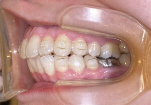 秋葉原リヨンドール歯列矯正歯科クリニック マウスピース矯正 インビザライン リテーナー 保定期間 後戻り