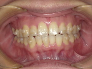 インビザラインマウスピース矯正 秋葉原リヨンドール歯列矯正歯科クリニック