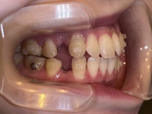 秋葉原リヨンドール歯列矯正歯科クリニック インビザライン マウスピース矯正 矯正専門医