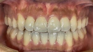 リテーナー 保定装置 保定期間 マウスピース矯正 インビザライン