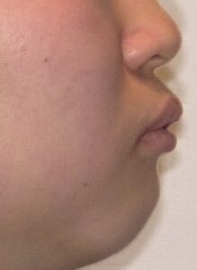 秋葉原リヨンドール歯列矯正歯科クリニック マウスピース専門 インビザライン Eライン 出っ歯 口ゴボ 人中