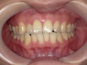 秋葉原リヨンドール歯列矯正歯科クリニック インビザライン 症例写真 部分矯正 プチ