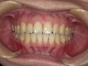 秋葉原リヨンドール歯列矯正歯科クリニック インビザライン マウスピース矯正 症例写真 部分矯正 プチ