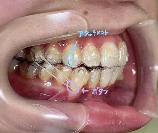 インビザラインマウスピース矯正 秋葉原リヨンドール歯列矯正歯科クリニック 顎間ゴム