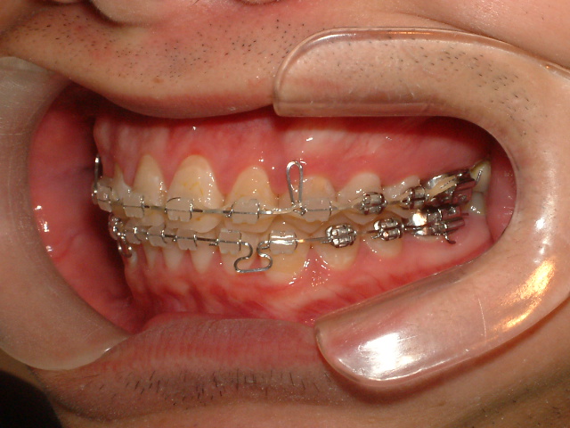 ワイヤー矯正 金属アレルギーのリスク