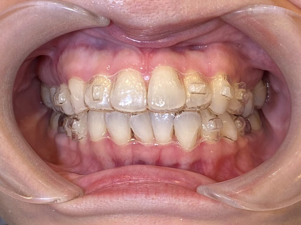 秋葉原リヨンドール歯列矯正歯科クリニック マウスピース矯正 矯正歯科 インビザライン