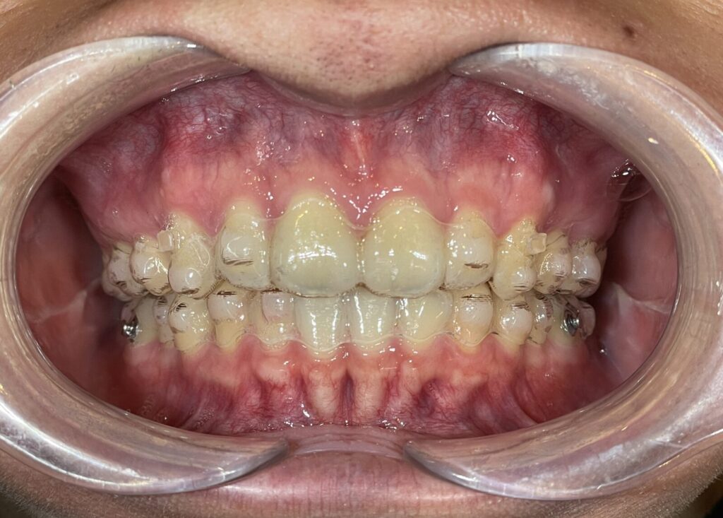 秋葉原リヨンドール歯列矯正歯科クリニック 矯正専門医 マウスピース矯正 インビザライン