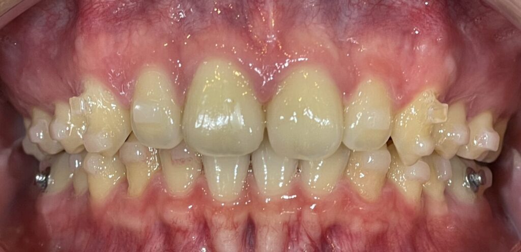 秋葉原リヨンドール歯列矯正歯科クリニック 矯正歯科 インビザライン マウスピース専門 正中線