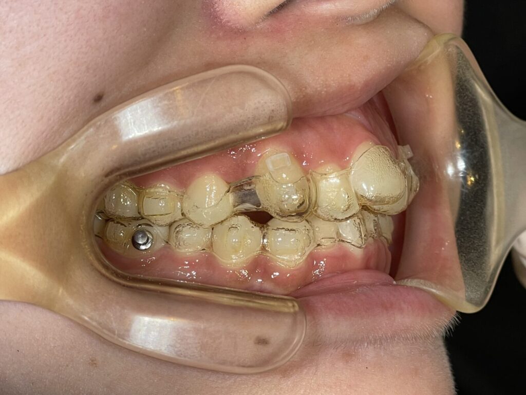 秋葉原リヨンドール歯列矯正歯科クリニック インビザライン マウスピース矯正