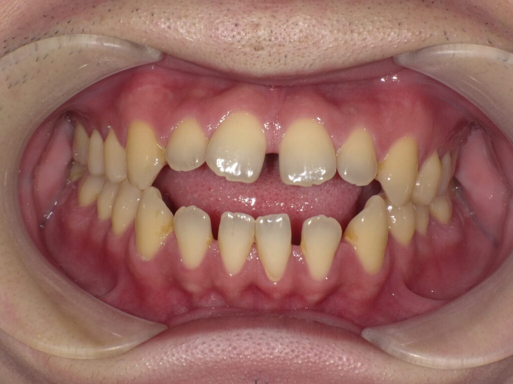 秋葉原リヨンドール歯列矯正歯科クリニック インビザライン マウスピース矯正 発音 滑舌 開咬