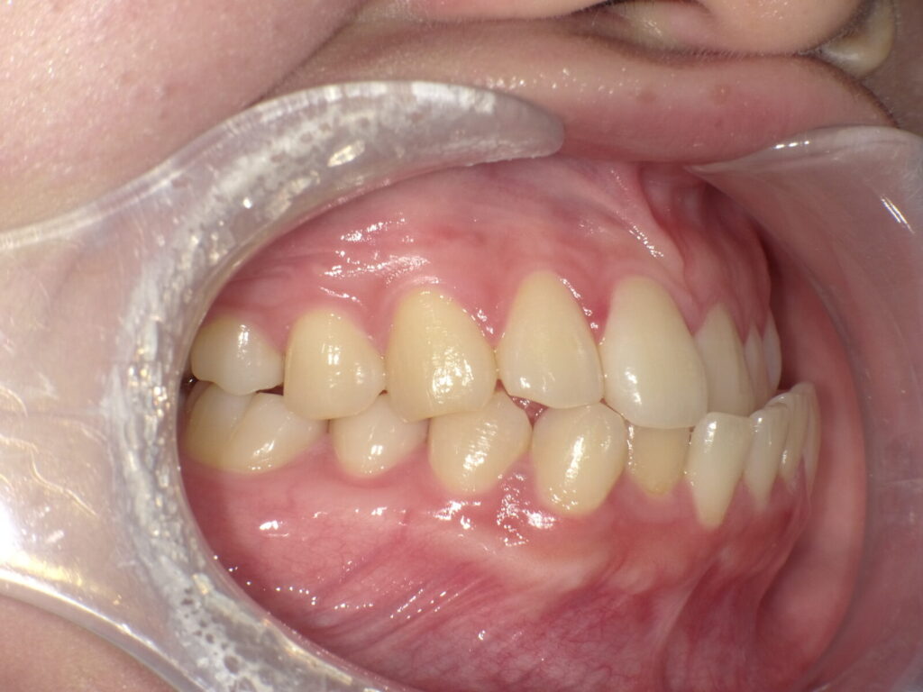 秋葉原リヨンドール歯列矯正歯科クリニック インビザライン マウスピース矯正 発音 滑舌