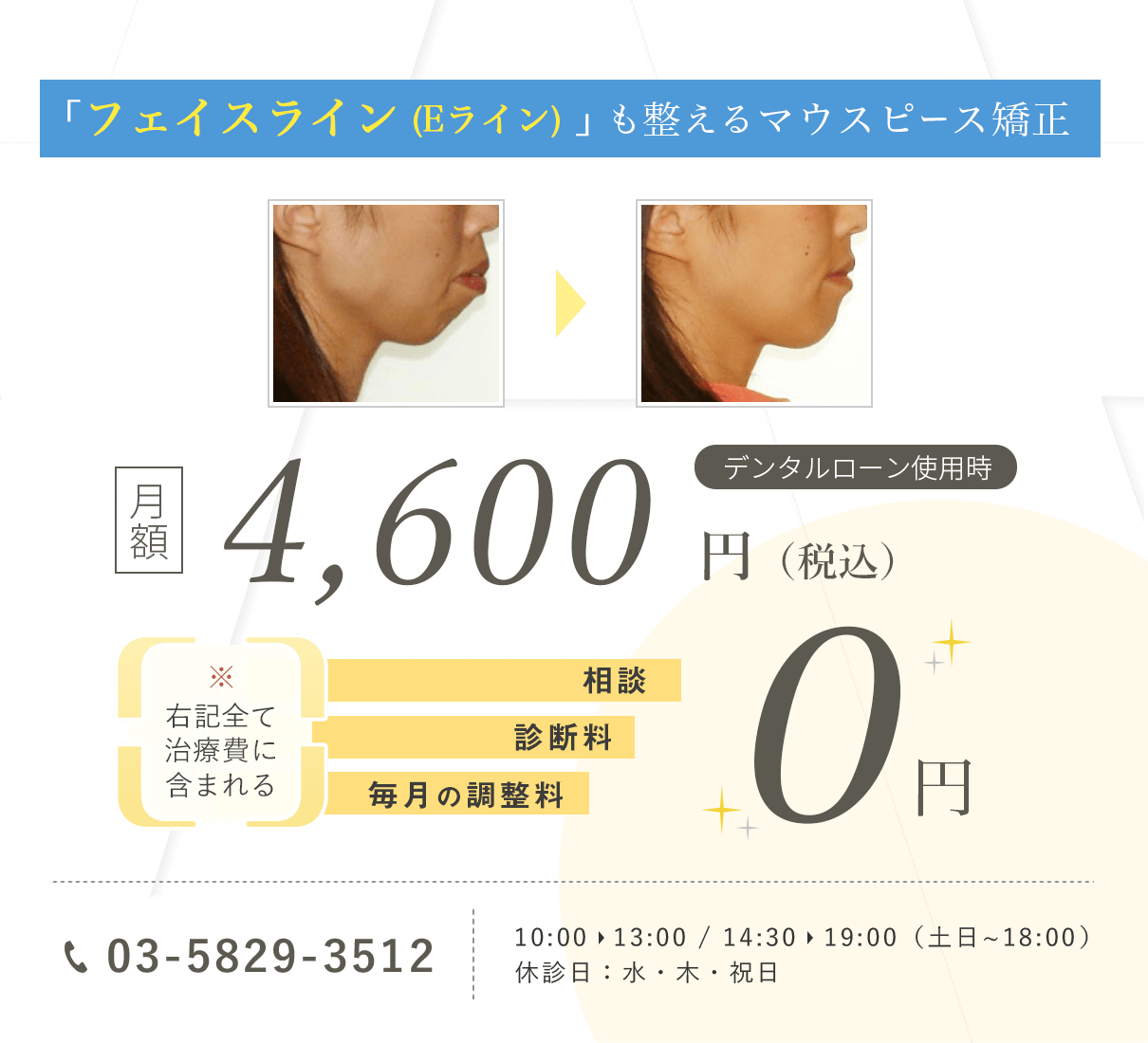 フェイスライン（Eライン）も整えるマウスピース矯正 デンタルローン使用時 月額4,600円（総額38.5万円／税込）