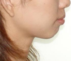 秋葉原リヨンドール歯列矯正歯科クリニック インビザライン マウスピース専門 矯正専門医 ほうれい線 スポット