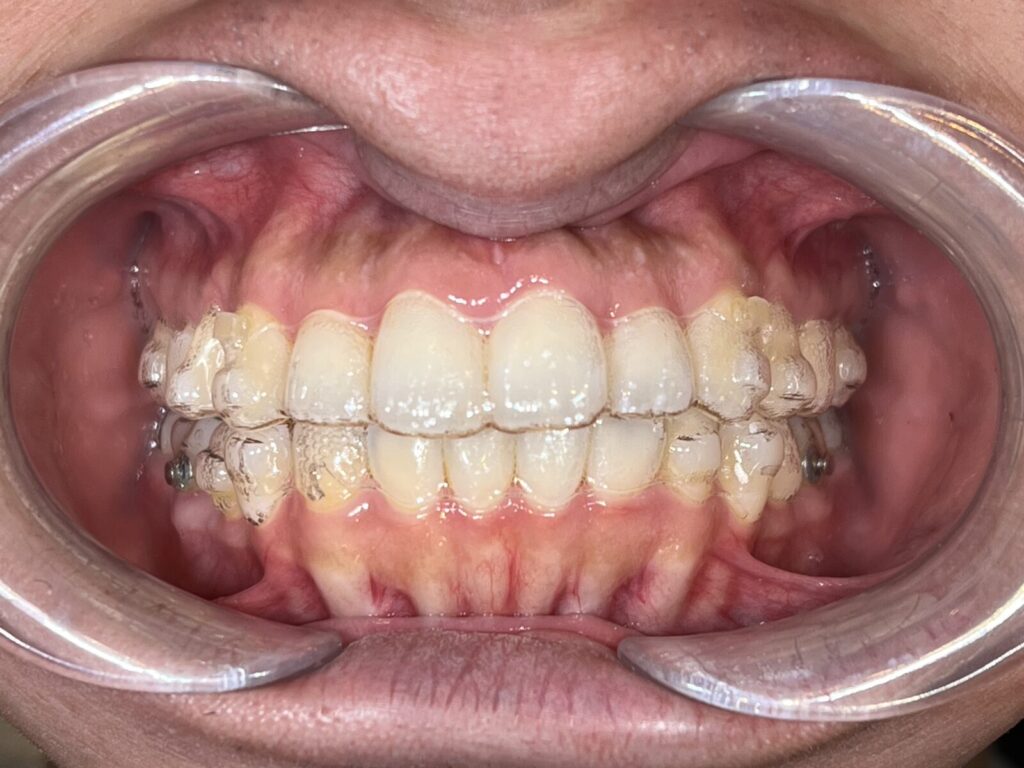 秋葉原リヨンドール歯列矯正歯科クリニック 矯正歯科 インビザライン マウスピース矯正